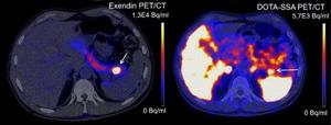 PET/CT scans of a patient with suspected insulinoma