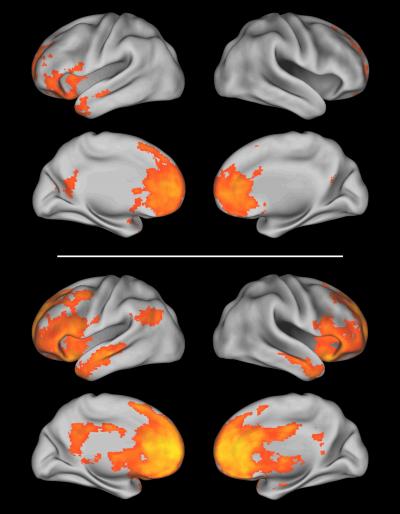 Front-Brain Activity Tied to Genetics, Autism (2 of 3)