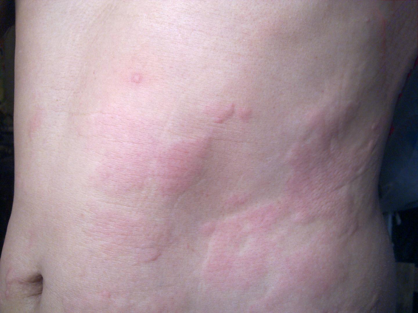 Signs of an allergic reaction to prednisone