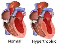 Comparison Between Normal and Hypertrophic Heart