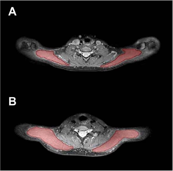 Exemplary cases for trapezius muscle segmentations.