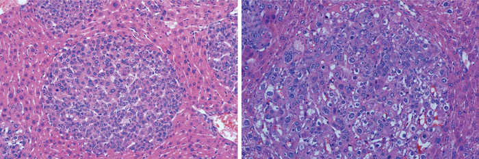Liver tumor subtypes