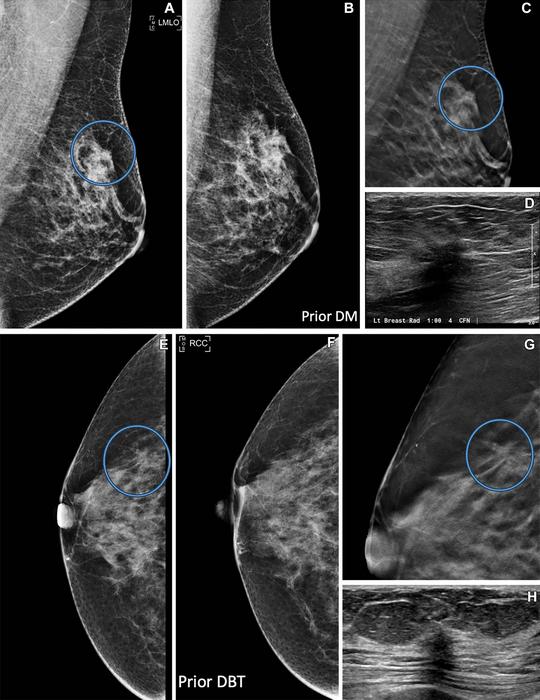 Breast images in (A–D) a 48-year-old female patient and (E–H) a 65-year-old female patient.