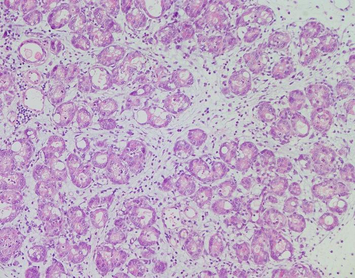 Pancreatic acinar cells undergoing inflammation