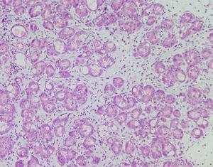 Pancreatic acinar cells undergoing inflammation