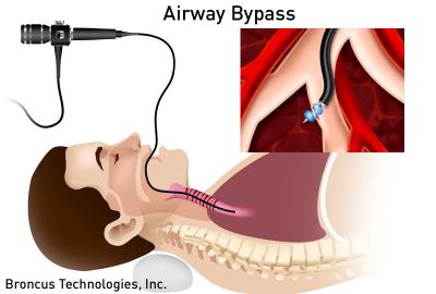Airway Bypass for Emphysema