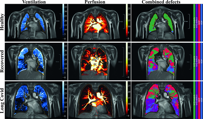 Lasting Lung Damage Seen in Children and Teens after COVID