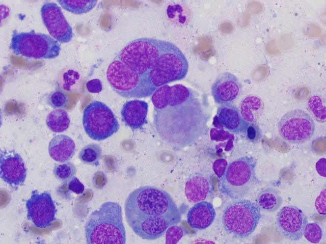 Promising Role for Whole Genome Sequencing in Guiding Blood Cancer Treatment