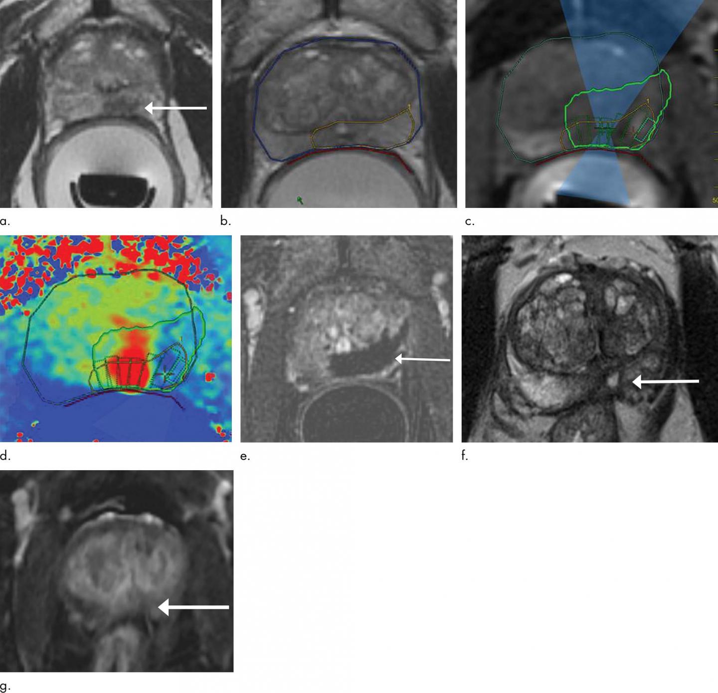 Ultrasound Technique Treats Prostate Cancer with Minimal Side Effects