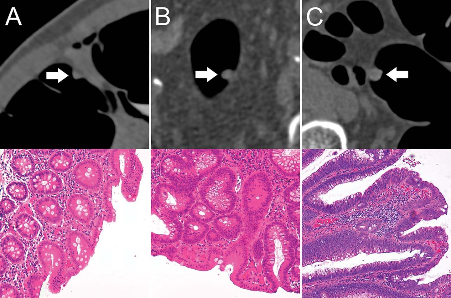 Machine Learning Method Identifies Precancerous Colon Polyps