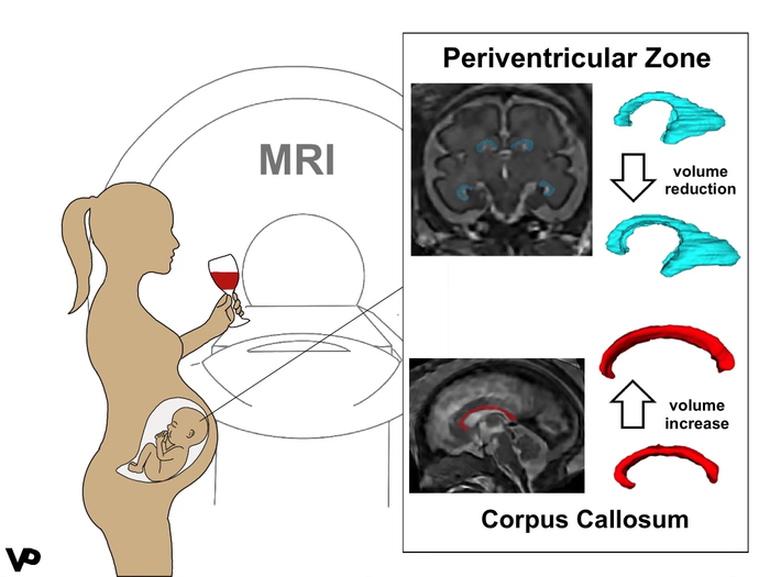 MRI Reveals Altered Brain Structure in Fetuses Exposed to Alcohol