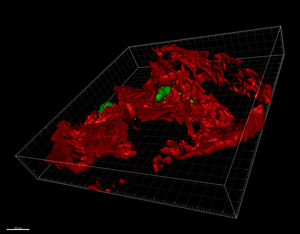 Breast cancer: why metastasis spreads to the bone