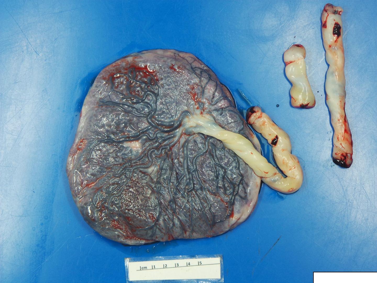 Fetal Side of a COVID-Impacted Placenta