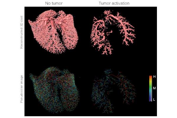 Inadequacies in Current Early-stage Lung Cancer Treatment Revealed