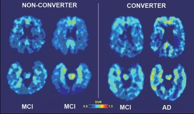 Brain Images Converting MCI to AD
