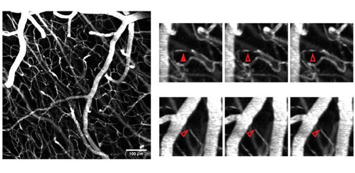 New Method for Detecting Blood Circulation Problems in Brain Capillaries