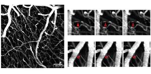 Bessel beam two-photon microscopy can be used to visualize capillaries in the brain. (Left) Maximum intensity projection to observe capillary stalling. (Right) Representative examples of different types of stalling events.