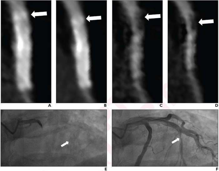 57-year-old man who underwent coronary CTA using two-breath-hold subtraction technique to assess patency of coronary artery stent.