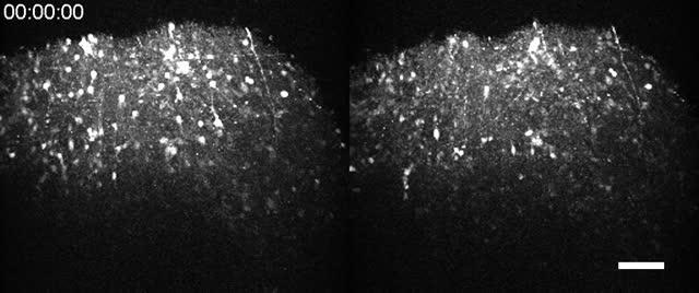 Before and after Drug Treatment on Angelman Patient's Mini Brain