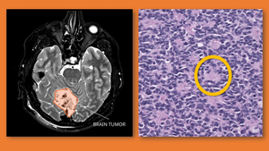 Medulloblastoma brain tumor