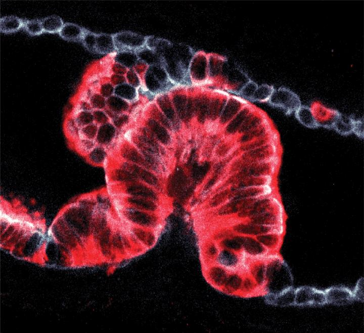 Cancer Growing In Pancreatic Duct