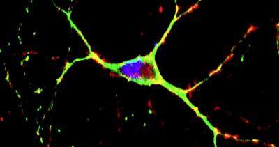 Berkeley Lab Scientists Help Develop Promising Therapy for Huntington's Disease