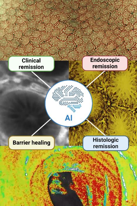 AI Offers New Era of Precision IBD Management