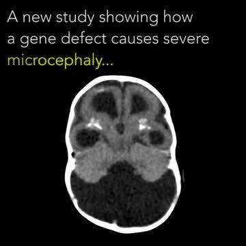 How Genetic Defects Cause Microcephaly