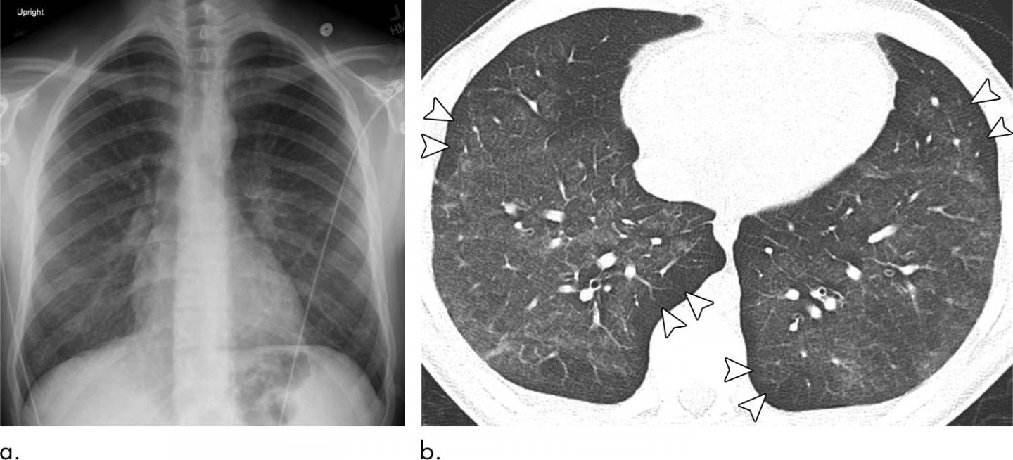 Study Looks at EVALI Findings in Teens (3 of 3)