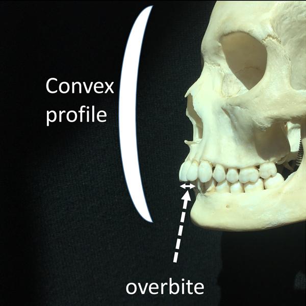 Overbite -- Concave Facial Structure