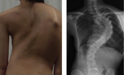 Adolescent Idiopathic Scoliosis
