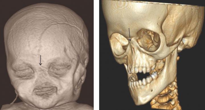 Gene Mutation Cause Lack of An External Nose