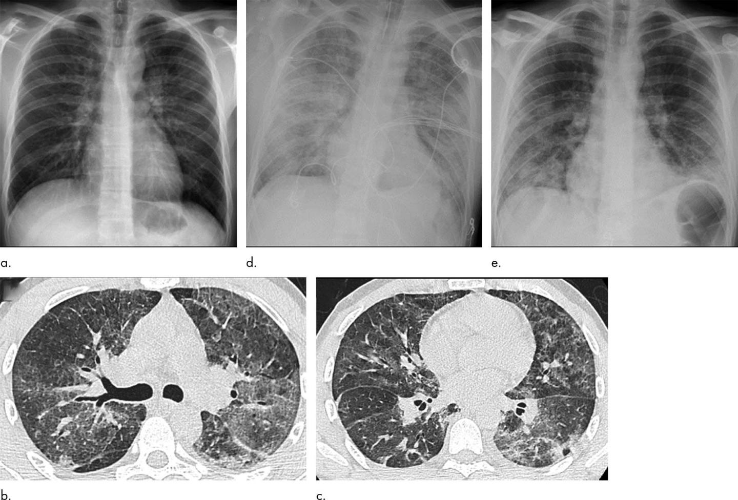 Lung Injuries from Vaping Have Characteristic Patterns on CT