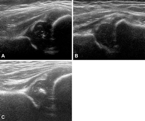 Ultrasound Technique Predicts Hip Dysplasia in Infants