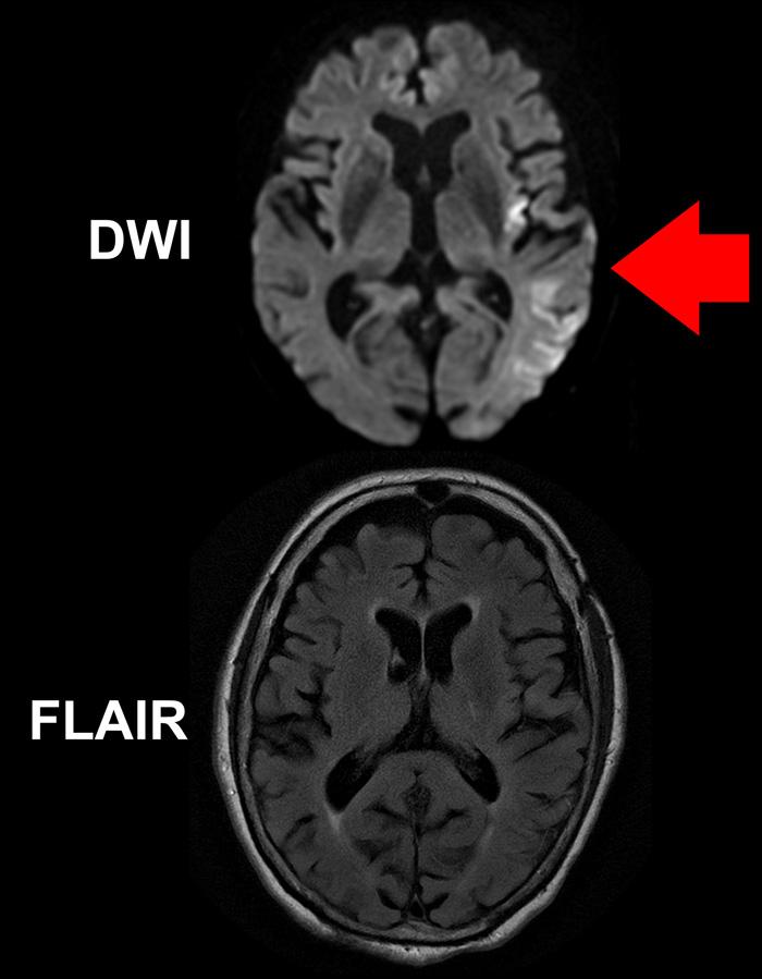 Imaging Mismatch Reveals Time since Stroke Symptom Onset