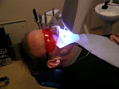 UV Light-Assisted Tooth Bleaching