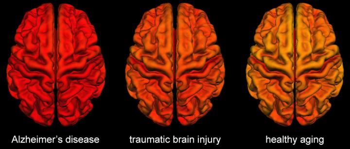 Cortical thickness: Alzheimer's disease, traumatic brain injury and healthy control