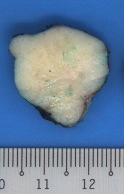 Excised Fibroadenoma
