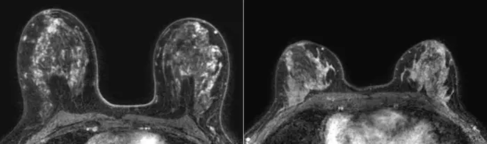 Representative transverse dynamic contrast-enhanced MRI scans in patients in the low and high tertiles of volume of enhancing parenchyma