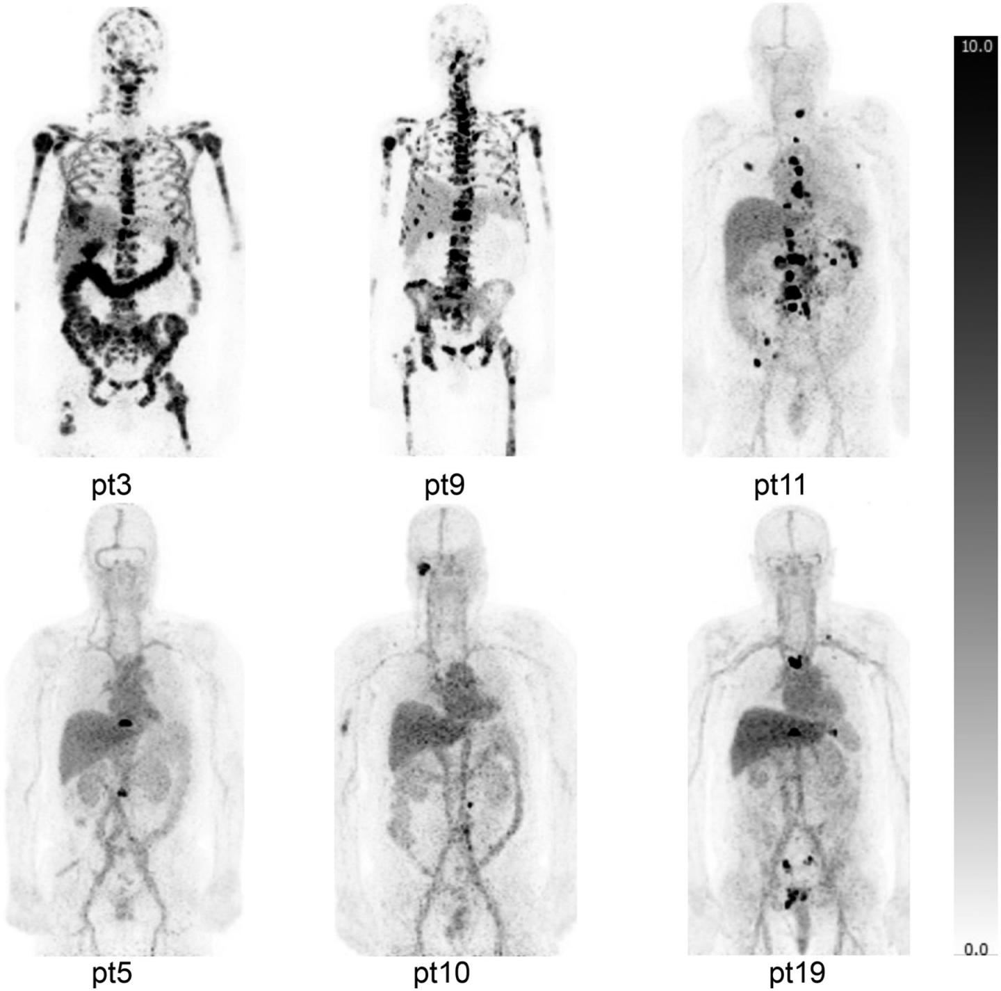 Zr-89-DFO-MSTP2109A Maximum-Intensity Projections of Patients with Bone Metastases