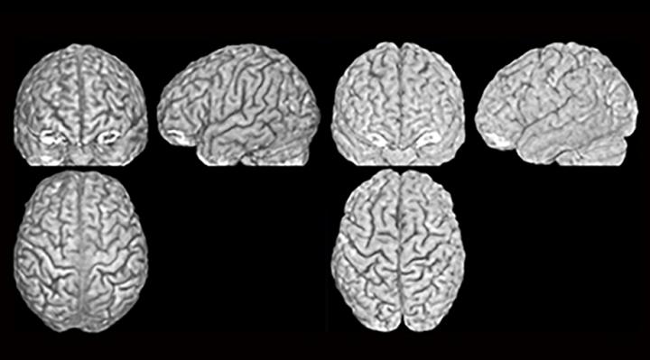 Three Brain Scans of Two Different Brains Belonging to Twins