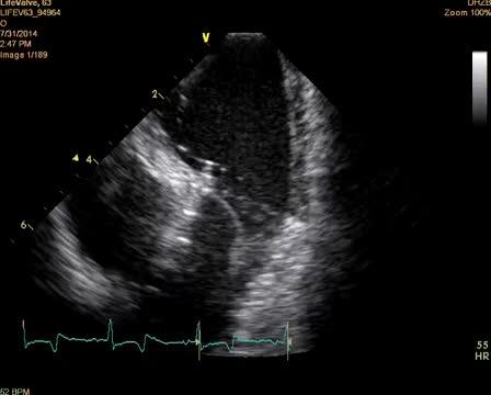 Growing Life-Like Heart Valves, Thanks to Help from Computational Modeling (3 of 3)