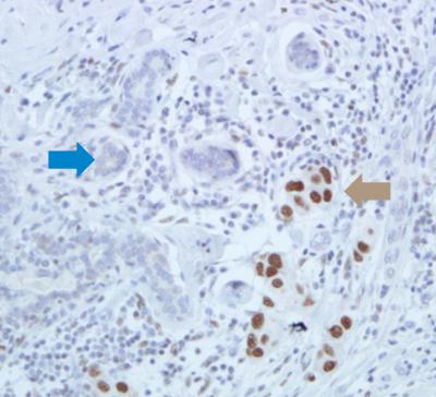 Breast Tissue Stained for Heat Shock Factor 1 Protein