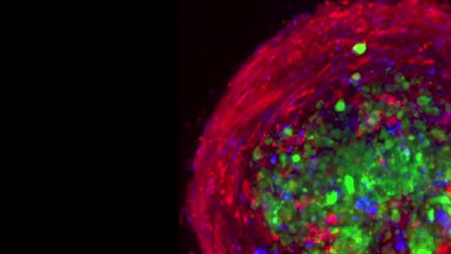 A New Way to Track Brain Cancer's Spread