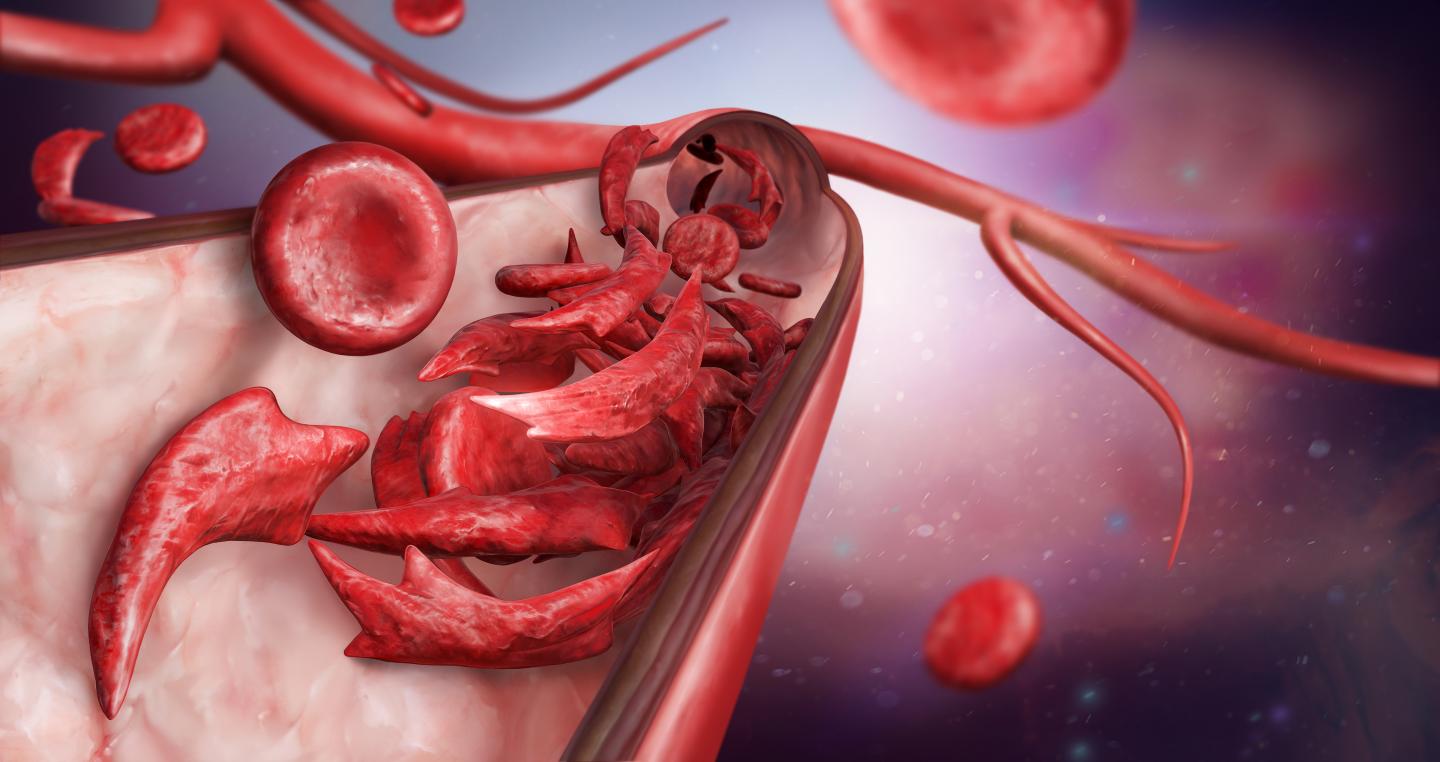 A Blood-Adhesion Monitor May Help Sickle Cell Disease Patients Manage Their Illness