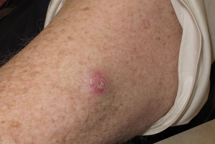 Merkel cell carcinoma lesion on left arm