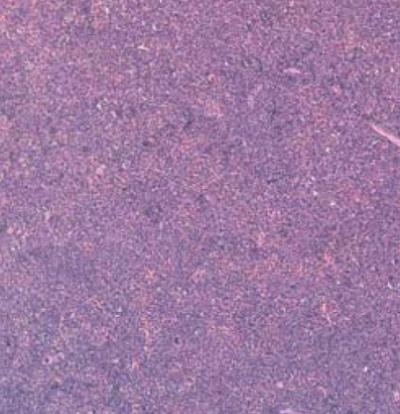 Mice Spleen Crowded with Leukemia Cells
