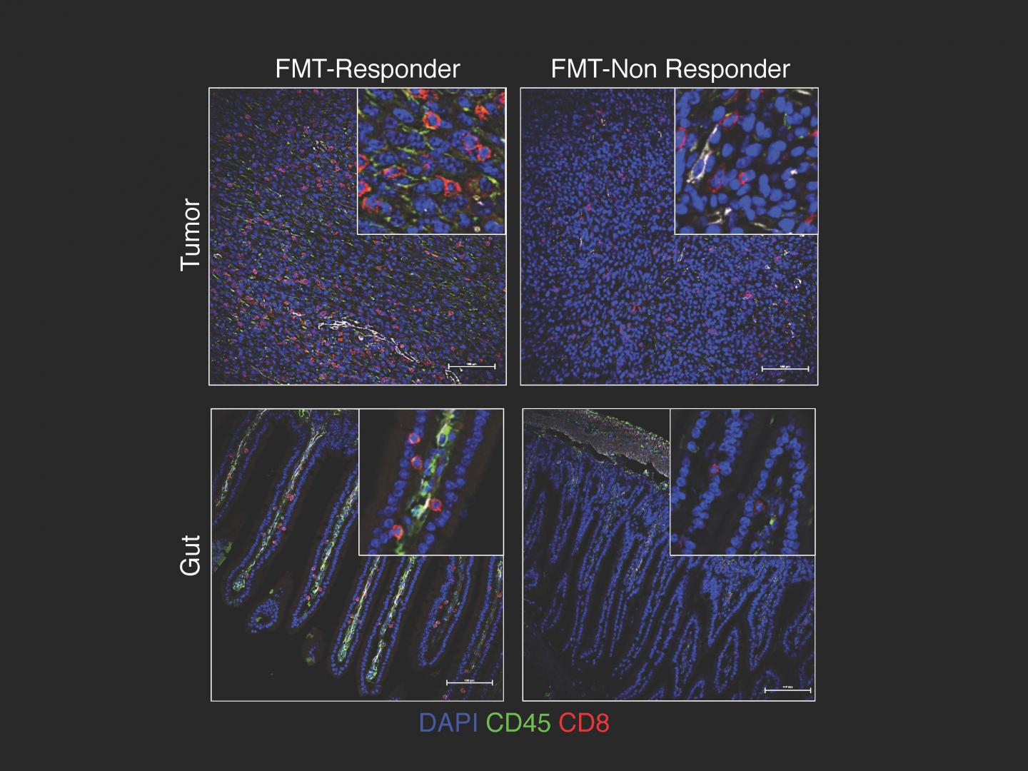 Unveiling Gut Microbes' Influence on Cancer Patient Response to Immunotherapy