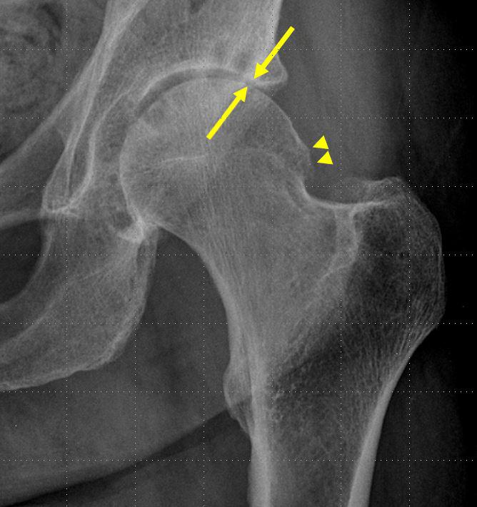 Hip Steroid Injections Associated with Bone Changes (1 of 2)