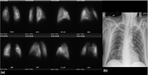 76-Year-Old, Positive for COVID-19